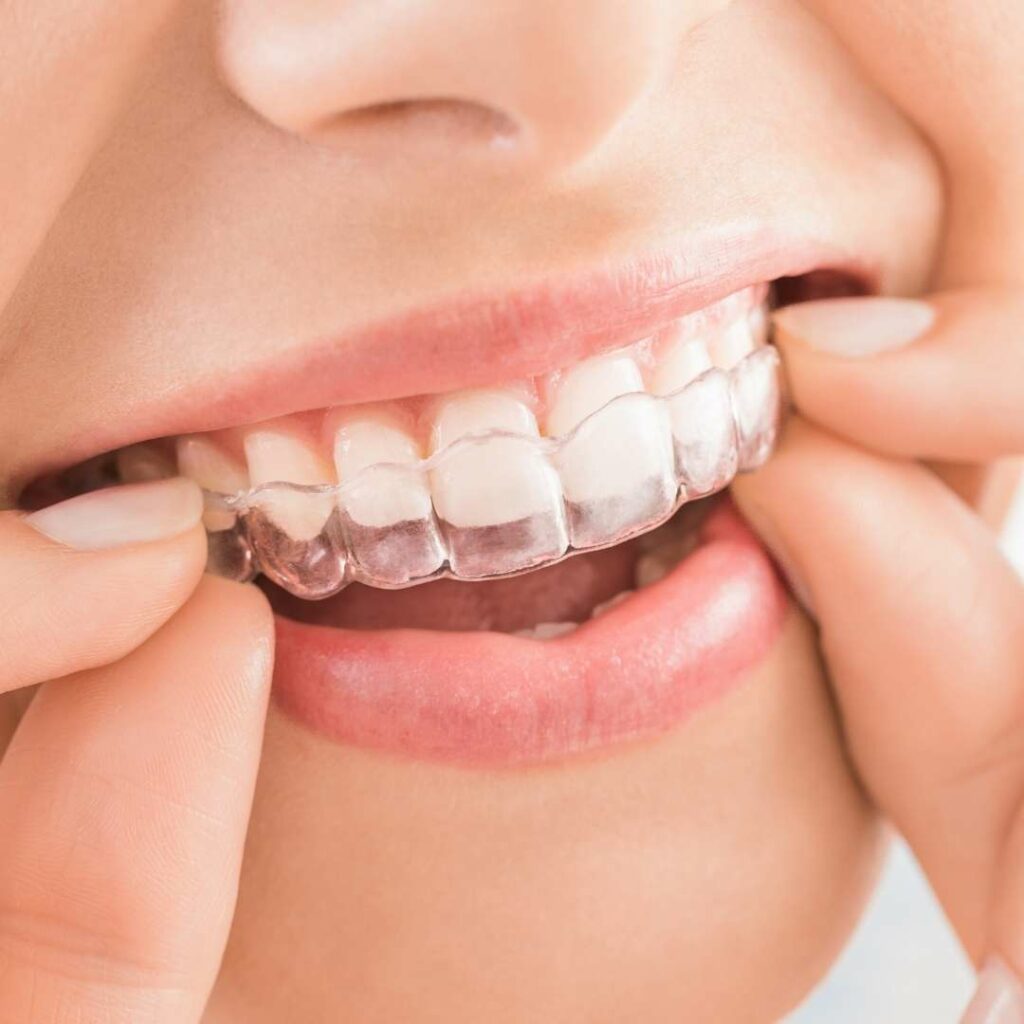 Benefits of Invisalign