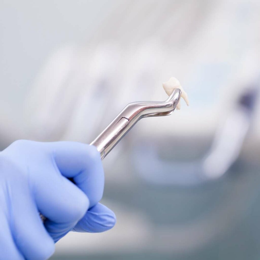 When do I need a Teeth Extraction