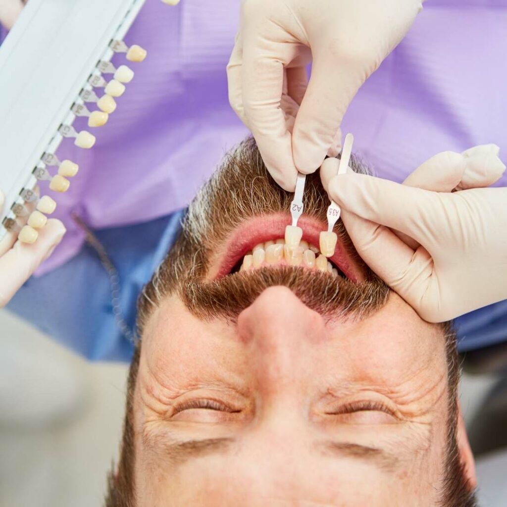 Benefits of Dental Veneers